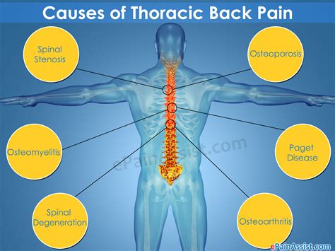 What Can Cause Thoracic Back Pain And How Is It Treated