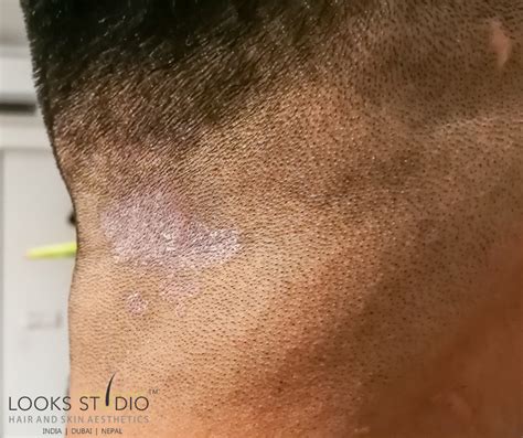 Ringworm Of The Scalp Tinea Capitis Causes Symptoms And 60 Off