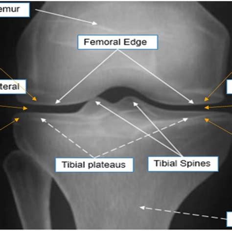 Radiographic Knee Anatomy And Oa Feature Locations Download