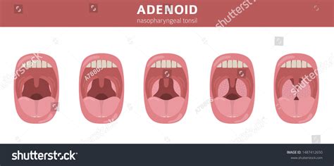 Nasal Throat Nasopharynx Diseases Adenoids Diagnosis Stock Vektor