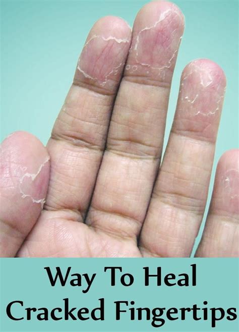 5 Way To Heal Cracked Fingertips Cracked Fingertips Peeling