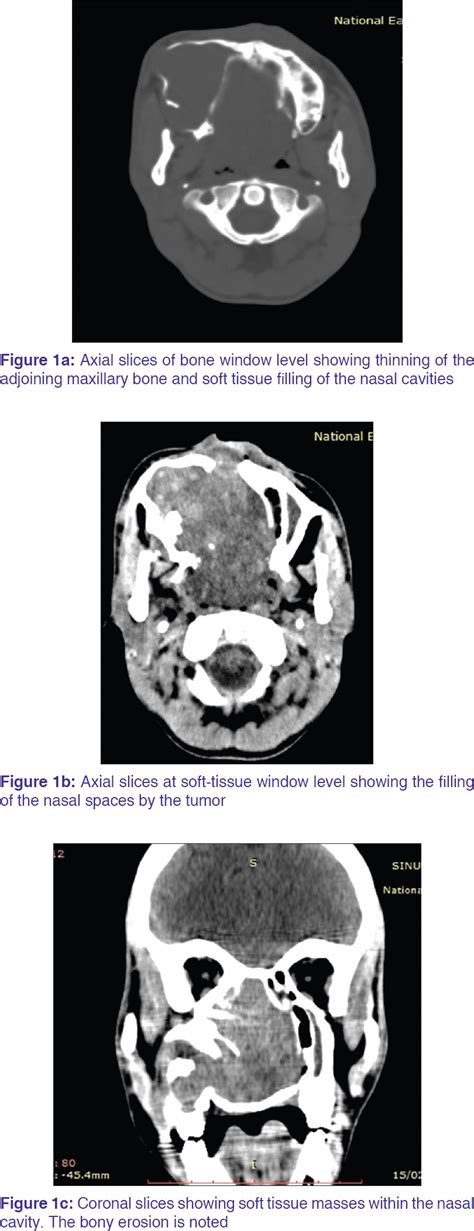 Computed Tomographic Findings Of Sinonasal Granulomatous Mucormycosis