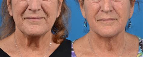 Patient 122406449 Profile Neck Lift Before And After Photos Clevens