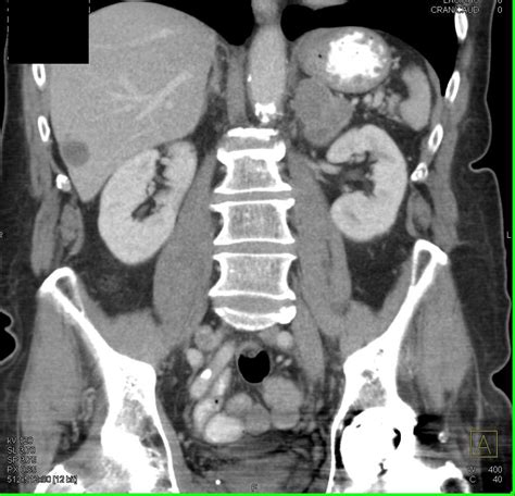 Petct Positive For Left Adrenal Adenoma As An Incidental Finding