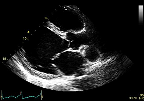 Echocardiography In The Diagnosis Of Cardiomyopathies Current Status