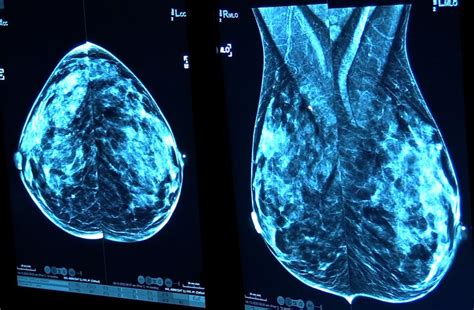 Breast Cancer Survivor Urges Women To Talk To Doctors About Their