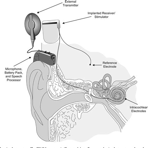 Pdf Cochlear Implants A Remarkable Past And A Brilliant Future
