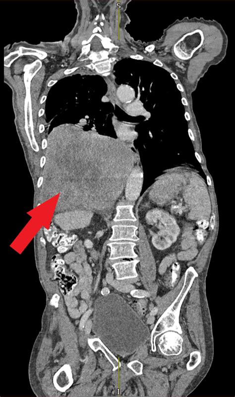 Ct Thorax‐abdomen‐pelvis With A Large Mass The Large Heterogeneous