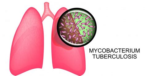 All the drugs must be taken for the entire length of the tb treatment. Similarities Between Sarcoidosis and Tuberculosis Make ...
