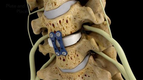 Spine Fusion Surgery Expert Chikitsa