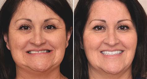 Changes In The Chin With Age Bedford Skin Clinic