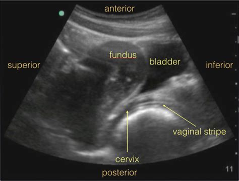 Figure Sagittal Transabdominal Pelvis View StatPearls NCBI Bookshelf