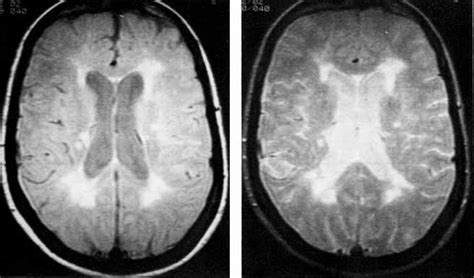 A Diffuse Periventricular White Matter Lesions Are Seen Outlining The
