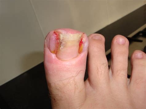 Ingrown Toenails Eltham Foot Clinic Your Foot Doctors