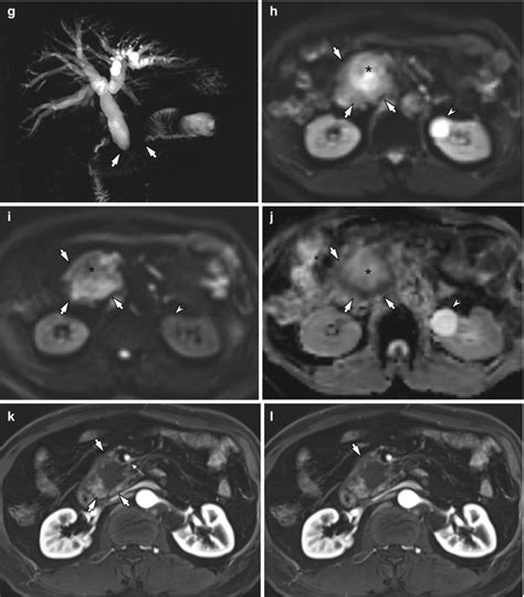 If a pancreatic mass is seen, that raises the suspicion of. Imaging Diagnosis of Pancreatic Cancer: CT and MRI ...