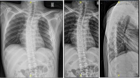 Plain X Ray Left Chest X Ray Ap View Showed Homogenous Consolidation