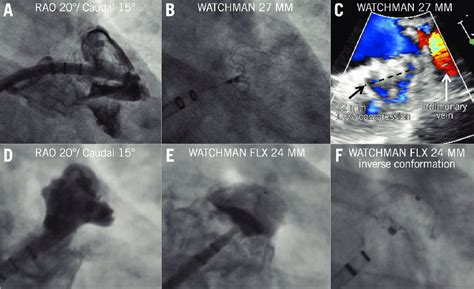Step By Step Implantation Of The Watchman A C And Watchman Flx D F