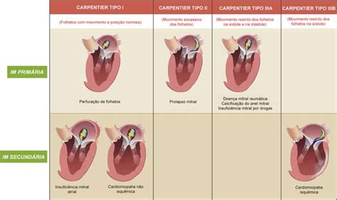 Regurgitação Mitral Discreta Sintomas