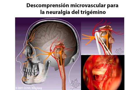 Descomprensión Microvascular Para El Tratamiento De La Neuralgia Del