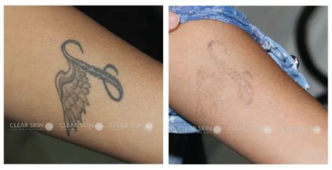 Discover More Than 63 Tattoo Removal Before And After Photos Latest