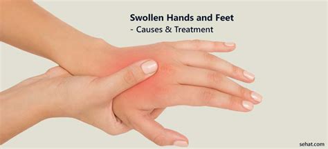 How To Reduce Swelling In Hands And Feet Possibilityobligation5