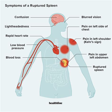 Symptoms Of A Ruptured Spleen And When To Seek Help
