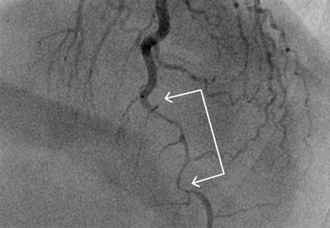 Spontaneous Coronary Artery Dissection Principles Of Management