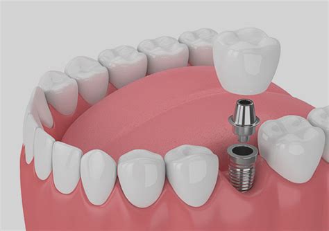 Single Tooth Implant Stamfor Dental Implant Specialist