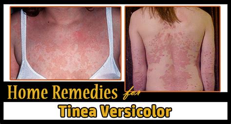 Hyperpigmentation on the skin of the upper body is a potential sign of tinea versicolor. Home Remedies for Tinea Versicolor - Remedies Lore