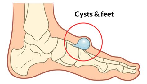 Understanding Ganglions In Feet Consulting Footpain