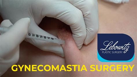 Gynecomastia Surgery Post Op Care Kenalog Shot YouTube