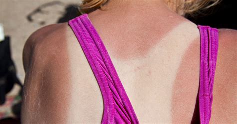 How To Treat Sunburn Fast Factors And More