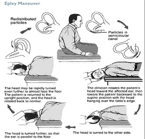 Image Result For Epley Maneuver Patient Handout Exercising Epley