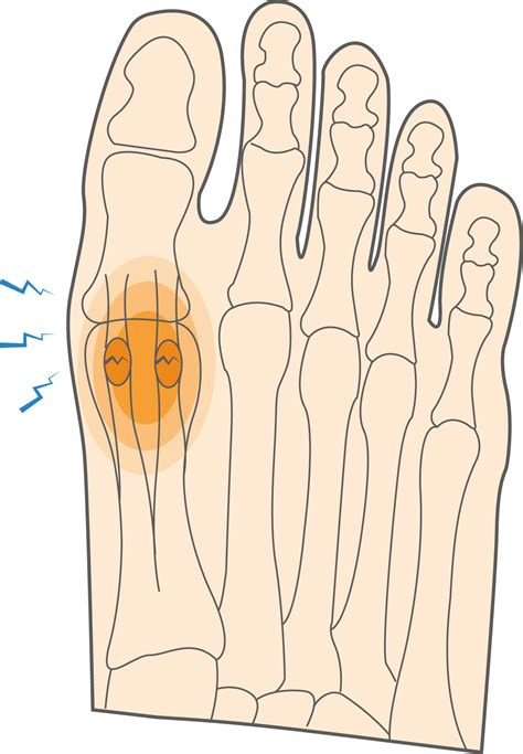 What Is A Sesamoid Fracture And How To Manage Foot Injuries Upswing Health