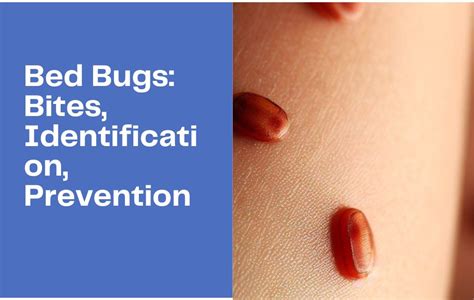 Bed Bugs Bites Identification Prevention And How To Choose The Bes