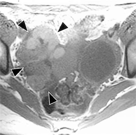 Ovarian Teratomas Tumor Types And Imaging Characteristics Radiographics