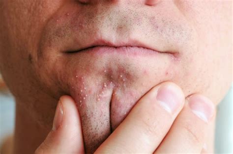 How To Treat Different Types Of Acne The Healthy