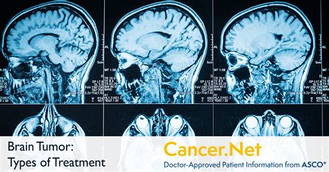 Brain Tumor Types Of Treatment Cancernet