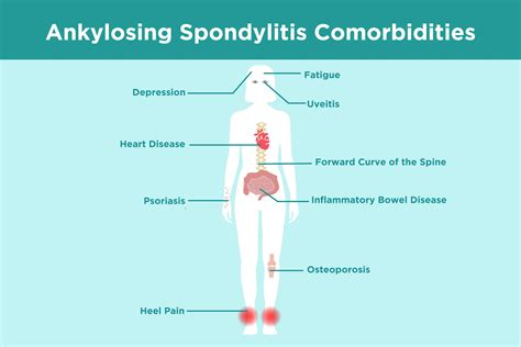 Ankylosing Spondylitis Comorbidities What As Patients Need To Know