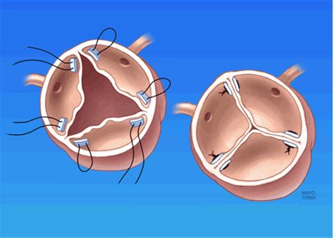 Aortic Valve Repair for Aortic Insufficiency | CTSNet