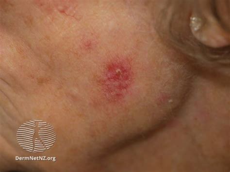 Pictures Of Melanoma And Other Skin Cancers