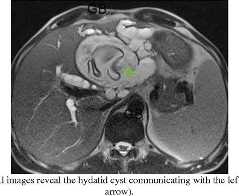 Figure 1 From Intra Biliary Rupture Of Hepatic Hydatid Cyst Presenting