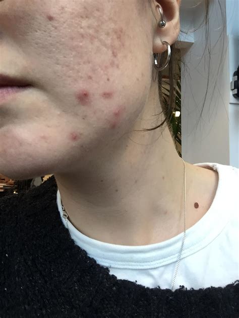 Acne Differin purge - how long did yours last ...