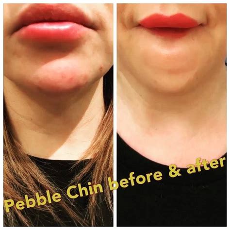 Peau Dorange Chin Dimpling Or Pebble Chin Is Caused By A Hyperactive