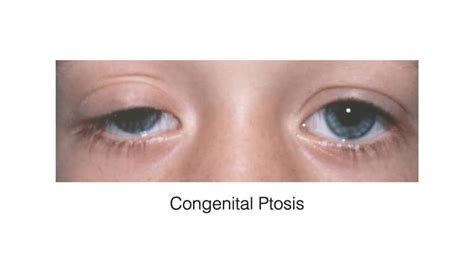 Ptosis Correction Surgery Causes And Treatment Dr Prasad Blog