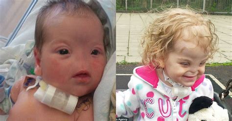 Heartfelt Hope 2 Year Old Girl Born Without A Nose Faces Pioneering