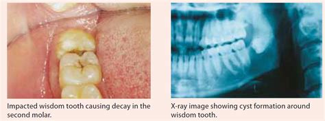 Impacted Wisdom Teeth Breeding Grounds For Bacteria May Cause Tooth