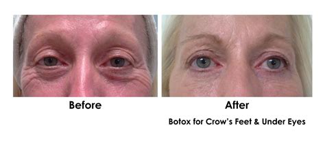 Share More Than Botox For Under Eye Bags Super Hot In Duhocakina
