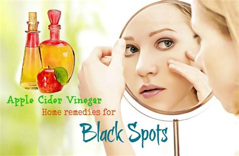 30 Best Natural Home Remedies For Black Spots On Face And Nose