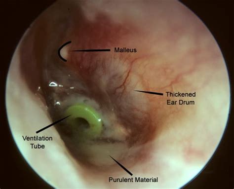 Chronic Ear Infection Images Mcgovern Medical School
